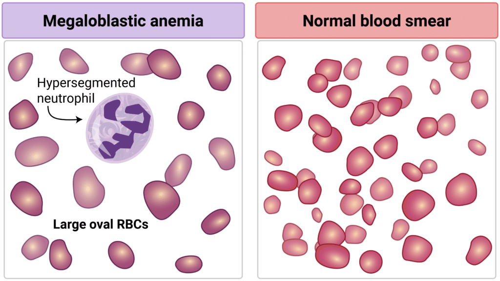 megaloblastic anemia peripheral smear