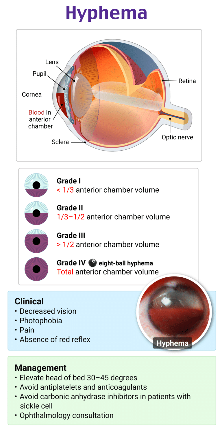 Rapid Review: Hyphema - RoshReview.com