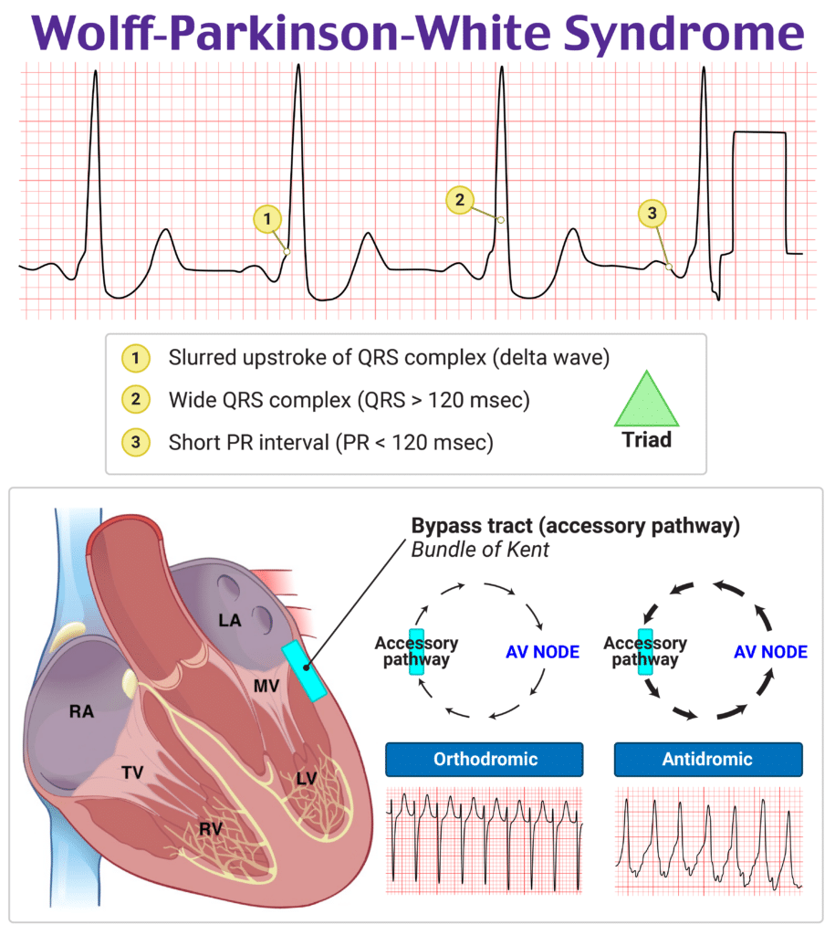 Rapid Review: Wolff-Parkinson-White (WPW) Syndrome - RoshReview.com