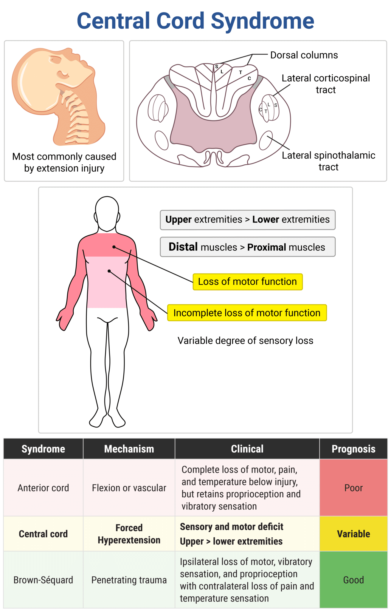 Rapid Review: Central Cord Syndrome - RoshReview.com