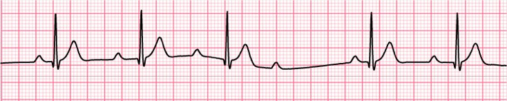 Podcast Ep 33: Heart Block, Hypothermia, Bullous Myringitis & More ...