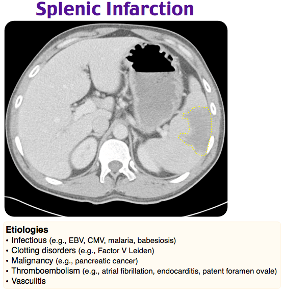 Rosh Review Location Of Infarct Emergency Medicine Medical Knowledge Hot Sex Picture 5081