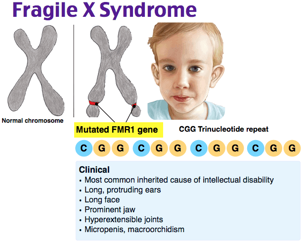 Fragile X Syndrome Facts