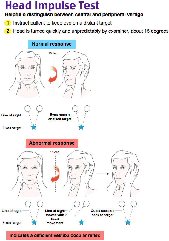 Image - Head Impulse Test, Vertigo - RoshReview.com