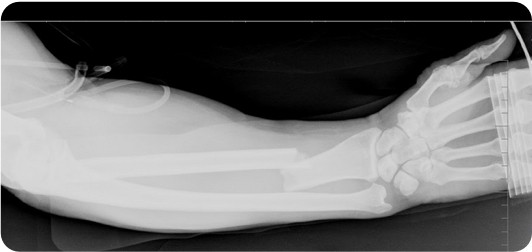 galeazzi fracture orthopedic surgery