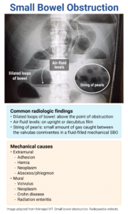 Rapid Review: Small Bowel Obstruction - RoshReview.com